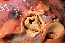 A stenotic aortic valve with severe stenosis due to rheumatic heart disease